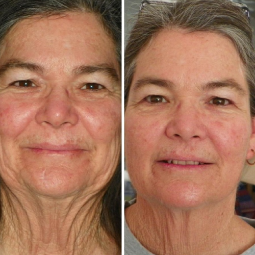 Before and after with XeiuC Collagen Oil